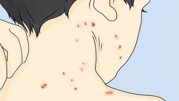 Awas, Virus 'Zombi' Herpes Zoster Bangkit Lagi!