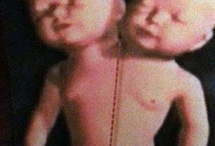 Bayi Kembar Siam Ini Hidup Berbagi Tangan dan Kaki