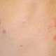 HERPES ZOSTER: Komplikasi Bikin Buta, Lansia Paling Berisiko