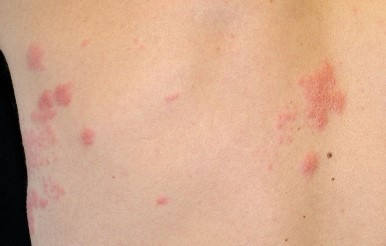 Herpes zoster/dermafoto.com