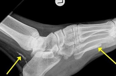 Astaga, Cacing Parasit Hidup di Kaki Pria Ini Selama Bertahun-tahun