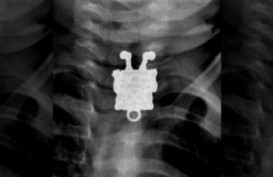 Paramedis Terkejut Melihat SpongeBob di Hasil Sinar X Balita