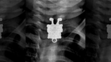Paramedis Terkejut Melihat SpongeBob di Hasil Sinar X Balita