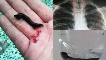 Astaga! Lintah Hidup Ini Gerogoti Tenggorokan Bocah