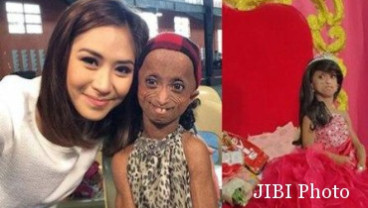 Gadis 18 Tahun Berwajah Nenek Karena Penyakit Langka