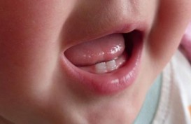 Risiko Kerusakan Gigi Pada Anak Harus Diwaspadai Hingga Usia 8 Tahun