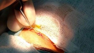 Cacing 12cm Ini Diangkat dari Kelopak Mata Seorang Wanita