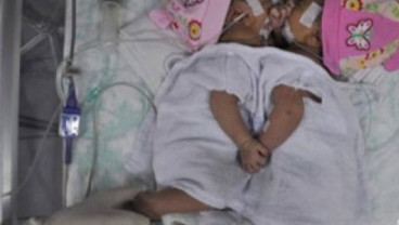 Bayi Kembar Dempet Dirawat di RS Hasan Sadikin