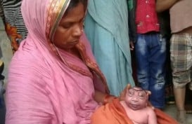 Kelainan Genetik, Bayi Lahir di India Mirip Alien