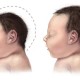 Zat Kimia pada Desinfektan dan Shampo Bikin Bayi Cacat Lahir