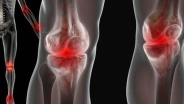 Cegah Osteoarthritis dengan Gaya Hidup Sehat