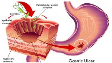 Mengenal Infeksi Helicobacter Pylori Penyebab dan Mengatasinya