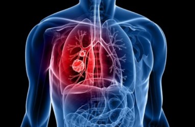 Penggunaan Imfinzi untuk kanker paru-paru Disetujui