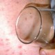 Wabah Meningitis di Nigeria Renggut 14 Nyawa