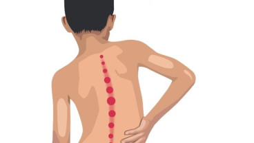Atasi Skoliosis Tanpa Operasi, Ini Caranya 
