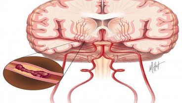 Petugas TPS di Palangka Raya Stroke setelah Bertugas