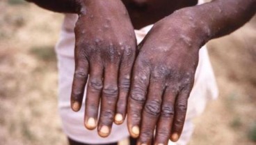 Monkeypox : Riau Waspadai Penularan Cacar Monyet dari Singapura