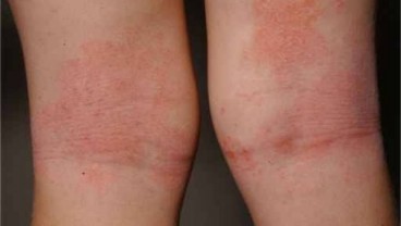  Dermatitis Atopik Tak Kenal Umur dan Gender