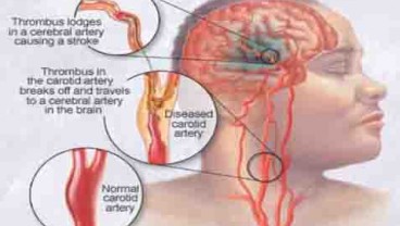 PTSD Tingkatkan Risiko Stroke Usia Dini