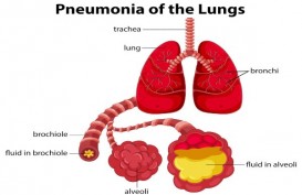 Wabah Pneumonia Misterius China Dikaitkan dengan Virus Corona Baru