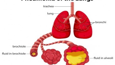 Wabah Pneumonia Misterius China Dikaitkan dengan Virus Corona Baru