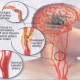 Mengenal Sindrom Metabolik, Si Penghantar Penyakit Struk Hingga Jantung