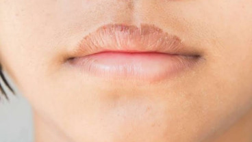 Cek Fakta : Bibir Kering dan Bersisik Jadi Gejala Virus Corona