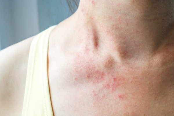 Ruam merah padda kulit menjadi gejala baru virus corona (Covid-19)./News Medical