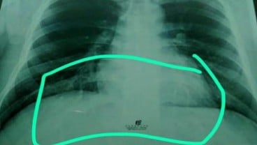 Waspada Virus Corona, Kenali Happy Hypoxia