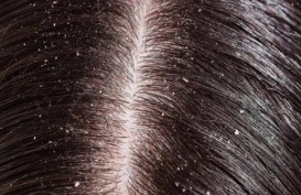 Kenali 5 Tanda Utama Masalah Pada Rambut