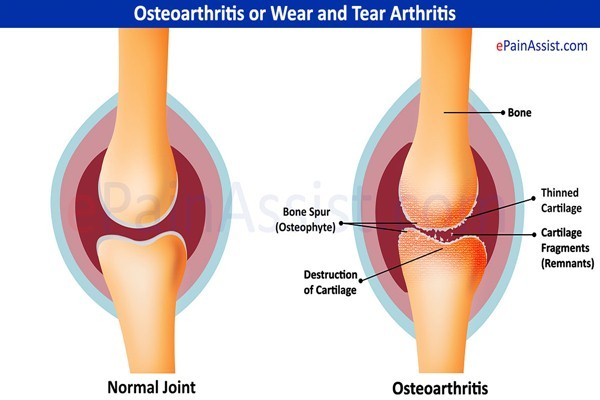 Osteoarthritis/epainassist.com