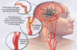Hindari Risiko Terkena Stroke Usia Muda, Lakukan Cara Berikut Ini