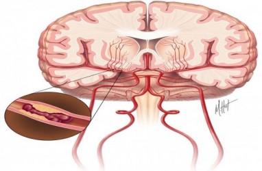 Gejala Stroke yang Tidak Boleh Diabaikan, dan Pedoman Darurat yang Diperlukan