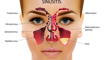 Makanan yang Harus Dikonsumsi dan Dihindari Penderita Sinus