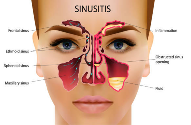 Makanan yang Harus Dikonsumsi dan Dihindari Penderita Sinus