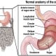 Kadar Gula Darah Tinggi Picu Gastroparesis, Apa Itu?