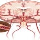 Perempuan Lebih Berisiko Terserang Stroke, Ini Penyebabnya