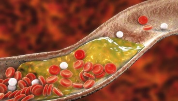 6 Tanda Kolesterol Tinggi yang Mengarah pada Stroke dan Serangan Jantung