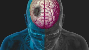 Tips Sederhana Turunkan Risiko Stroke, Lakukan Ini di Pagi Hari 