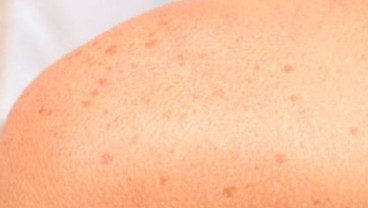12 Gejala Diabetes yang Muncul di Kulit Anda