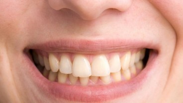 Mengenal Bruxism, Kebiasaan Menggemeretakkan Gigi yang Disebabkan Stres