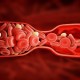 Kenali Penggumpalan Darah Akibat Covid-19 dan Cara Menanganinya