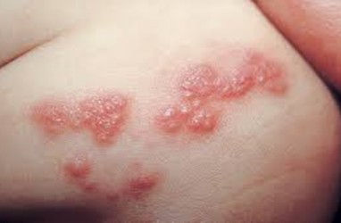 Ketahui Apa Itu Herpes, Gejala, Penyebab dan Cara Pengobatannya
