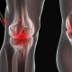 Ini Bedanya Lupus dan Rheumatoid Arthritis