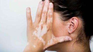 Pengidap Autoimun Vitiligo Boleh Disuntik Vaksin Covid-19, Asalkan....