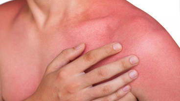Hati-hati, Eksim Parah Picu Peningkatan Risiko Stroke hingga 20 Persen