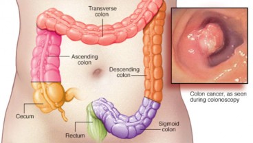 Ini Gejala Awal Kanker Usus Besar Pada Tubuh