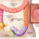 Ini Gejala Awal Kanker Usus Besar Pada Tubuh