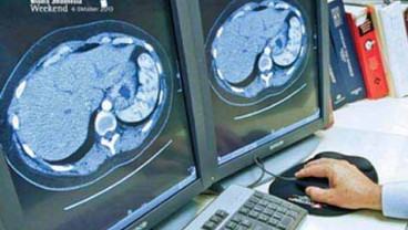 Orang Kidal Lebih Cepat Sembuh Jika Terserang Stroke 