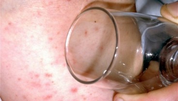 WHO: Wabah Meningitis di Kongo Tewaskan 129 Orang